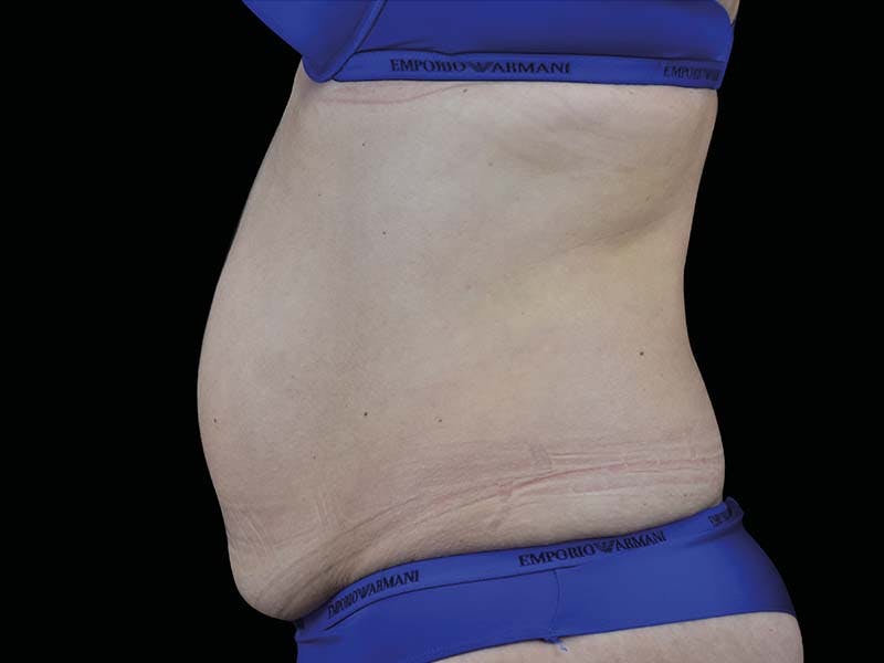 Emsculpt Neo Before & After Gallery - Patient 265019 - Image 1