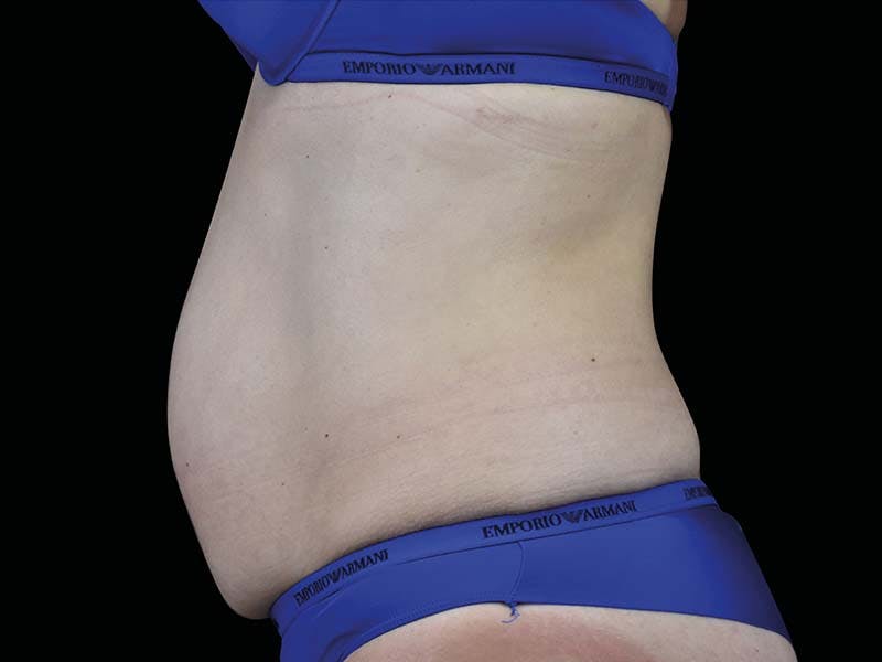 Emsculpt Neo Before & After Gallery - Patient 265019 - Image 2