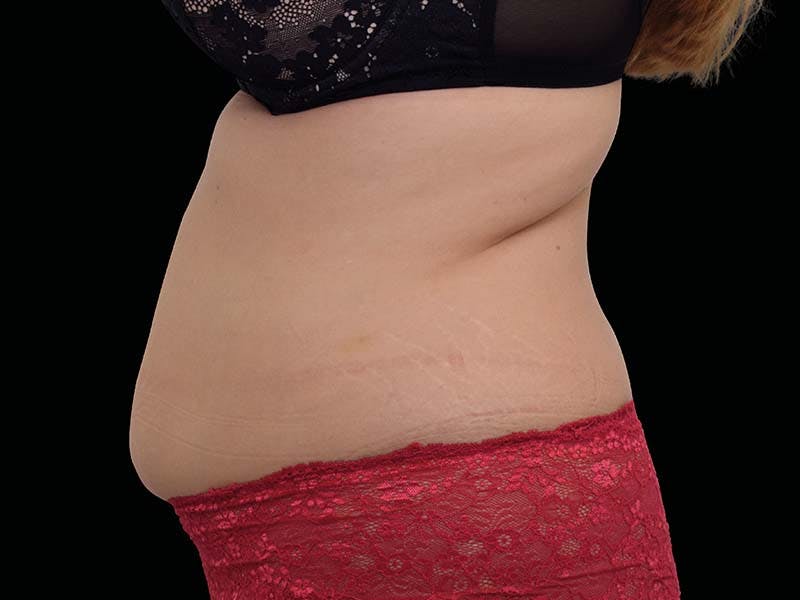 Emsculpt Neo Before & After Gallery - Patient 284002 - Image 1