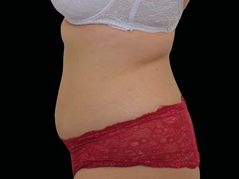 Emsculpt Neo Before & After Gallery - Patient 284002 - Image 2