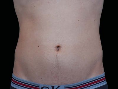 Emsculpt Neo Before & After Gallery - Patient 348986 - Image 1