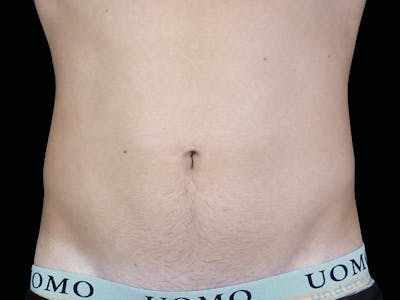Emsculpt Neo Before & After Gallery - Patient 348986 - Image 2