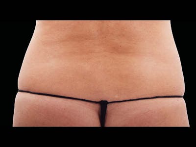 Emsculpt Neo Before & After Gallery - Patient 335096 - Image 2