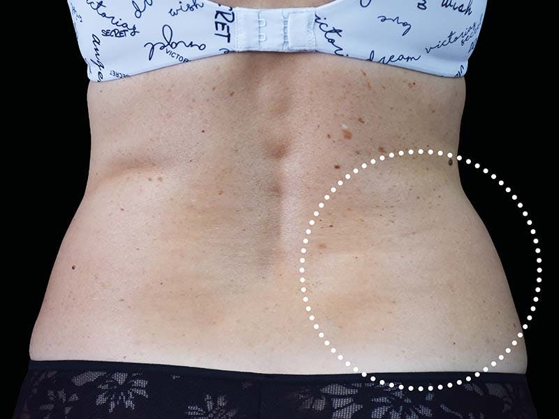 Emsculpt Neo Before & After Gallery - Patient 983854 - Image 1