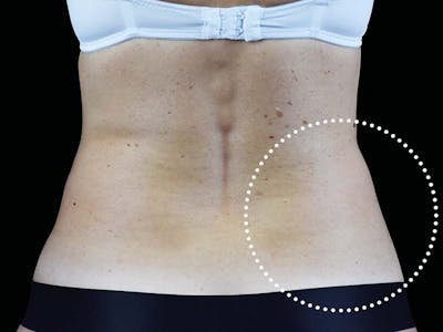 Emsculpt Neo Before & After Gallery - Patient 983854 - Image 2