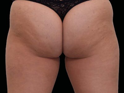 Emsculpt Neo Before & After Gallery - Patient 273604 - Image 1