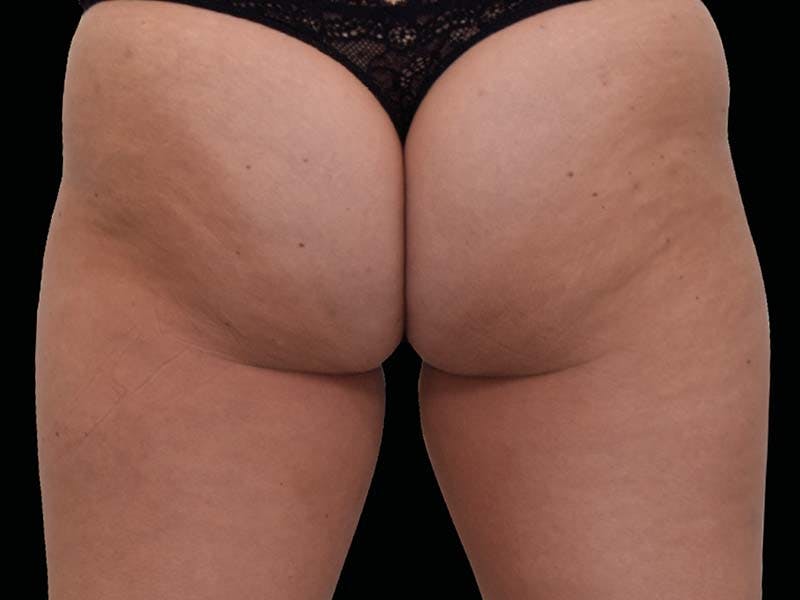 Emsculpt Neo Before & After Gallery - Patient 273604 - Image 1