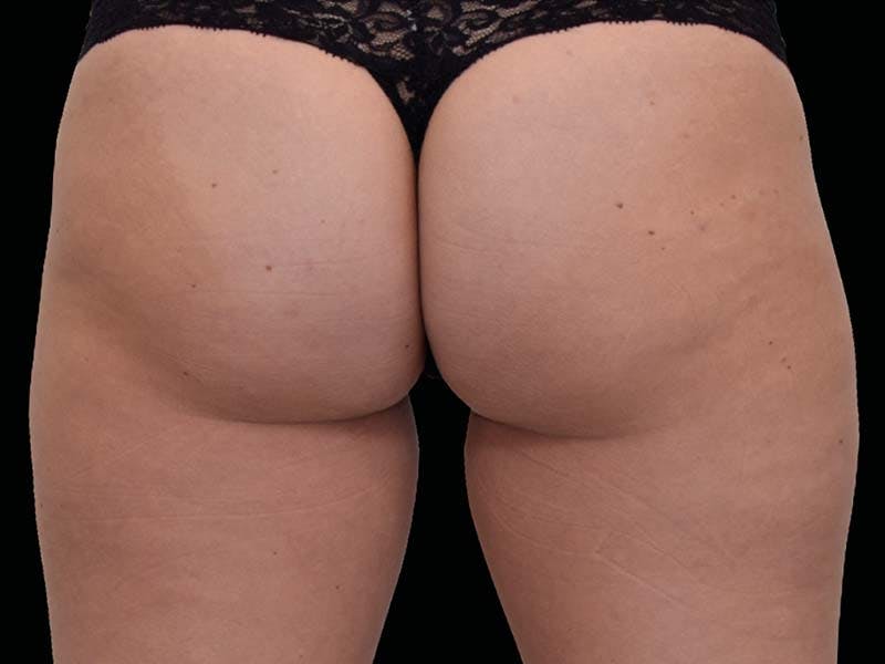 Emsculpt Neo Before & After Gallery - Patient 273604 - Image 2