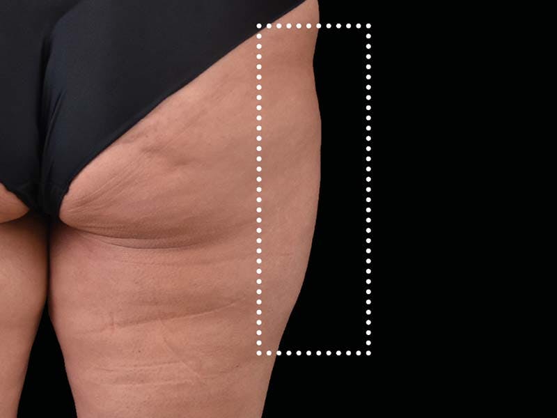 Emsculpt Neo Before & After Gallery - Patient 768765 - Image 1