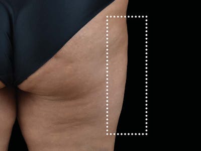 Emsculpt Neo Before & After Gallery - Patient 350651 - Image 2