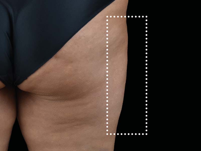 Emsculpt Neo Before & After Gallery - Patient 350651 - Image 2
