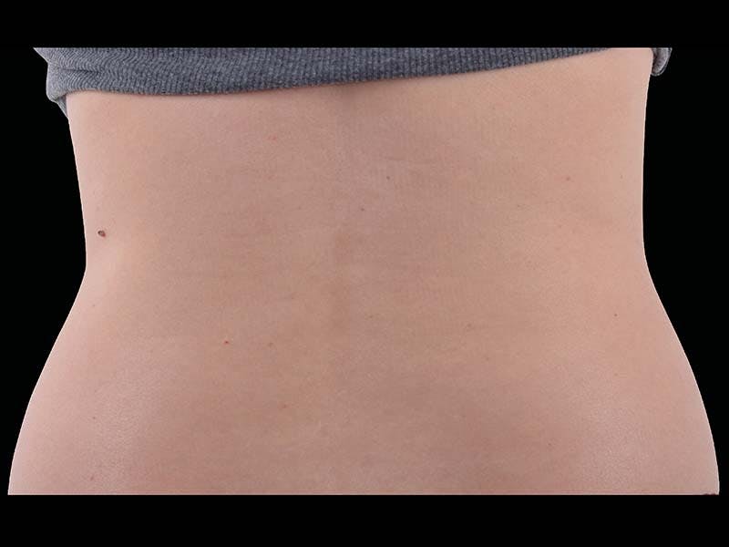 Emsculpt Neo Before & After Gallery - Patient 229410 - Image 2