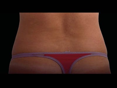 Emsculpt Neo Before & After Gallery - Patient 149401 - Image 2