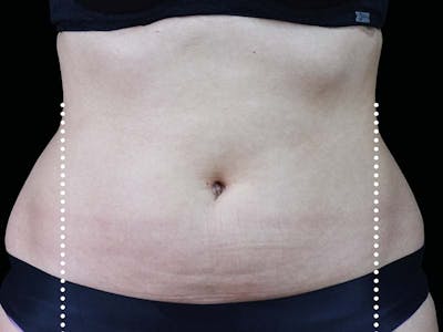 Emsculpt Neo Before & After Gallery - Patient 551558 - Image 1