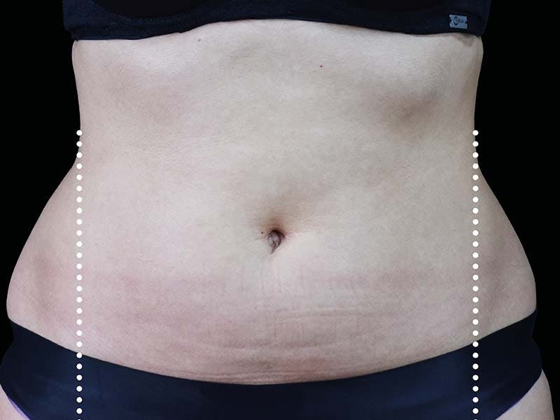 Emsculpt Neo Before & After Gallery - Patient 551558 - Image 1