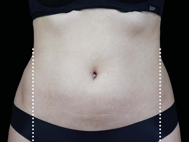 Emsculpt Neo Before & After Gallery - Patient 551558 - Image 2