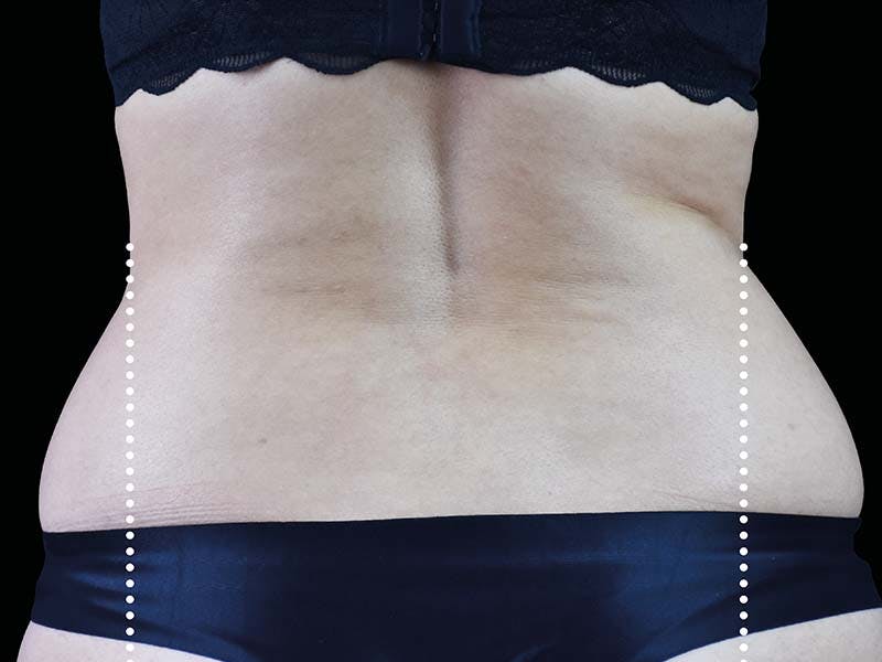 Emsculpt Neo Before & After Gallery - Patient 551558 - Image 3