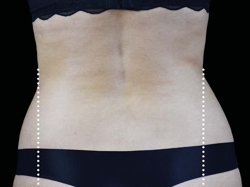 Emsculpt Neo Before & After Gallery - Patient 551558 - Image 4