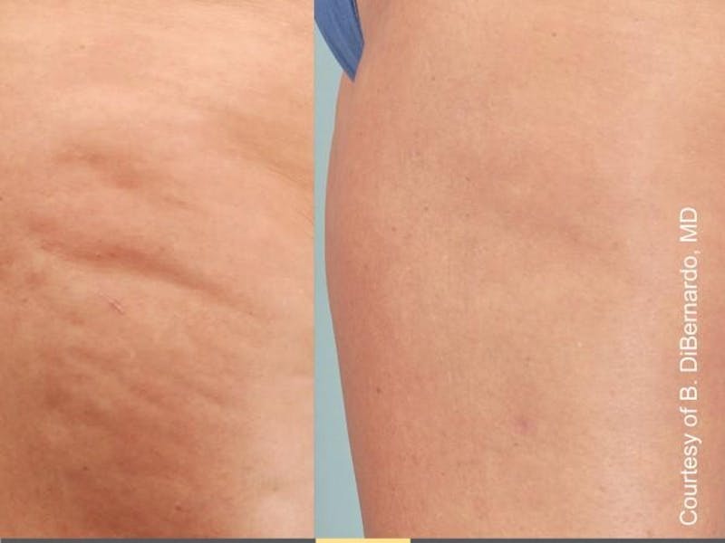 Cellulaze Before & After Gallery - Patient 405732 - Image 1