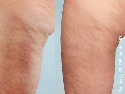 Cellulaze Before & After Gallery - Patient 405732 - Image 2