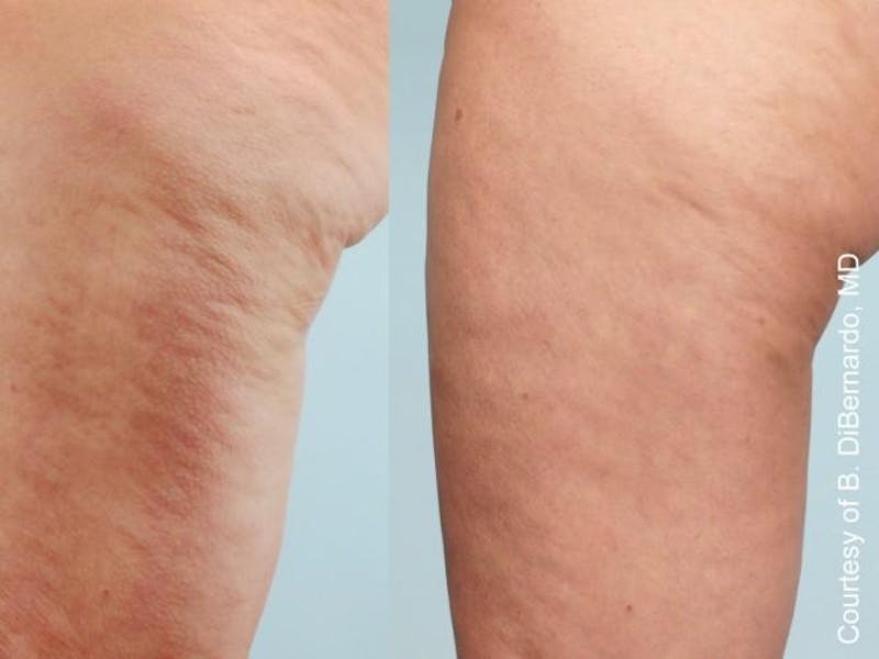 Cellulaze Before & After Gallery - Patient 405732 - Image 2