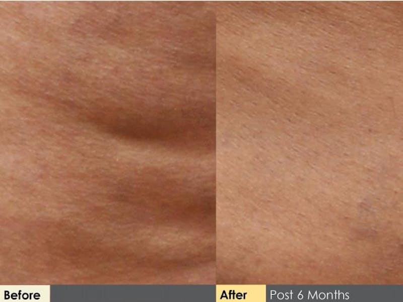 Cellulaze Before & After Gallery - Patient 405732 - Image 3