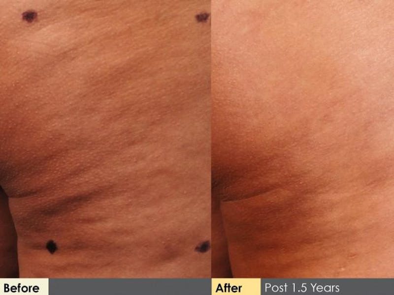 Cellulaze Before & After Gallery - Patient 405732 - Image 4