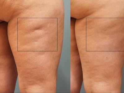 Cellulaze Before & After Gallery - Patient 912976 - Image 1