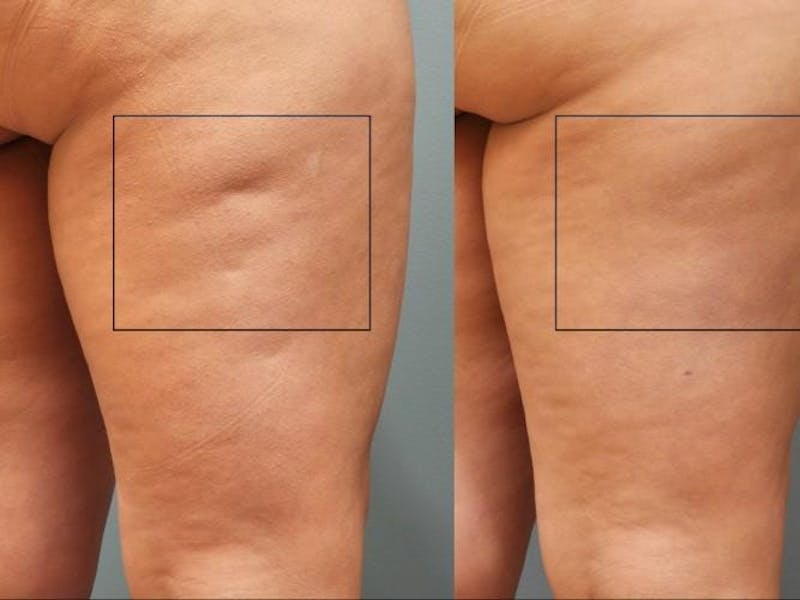 Cellulaze Before & After Gallery - Patient 912976 - Image 1