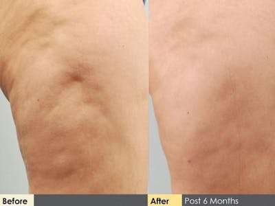 Cellulaze Before & After Gallery - Patient 912976 - Image 2