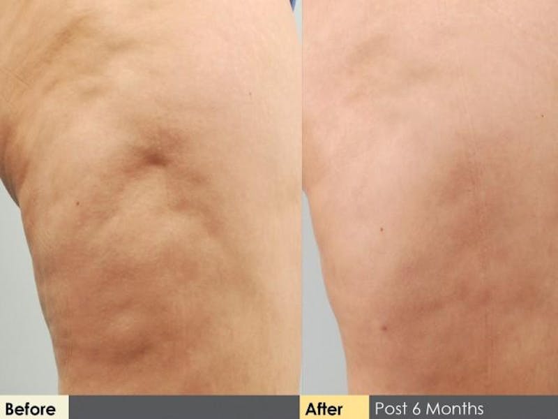 Cellulaze Before & After Gallery - Patient 912976 - Image 2