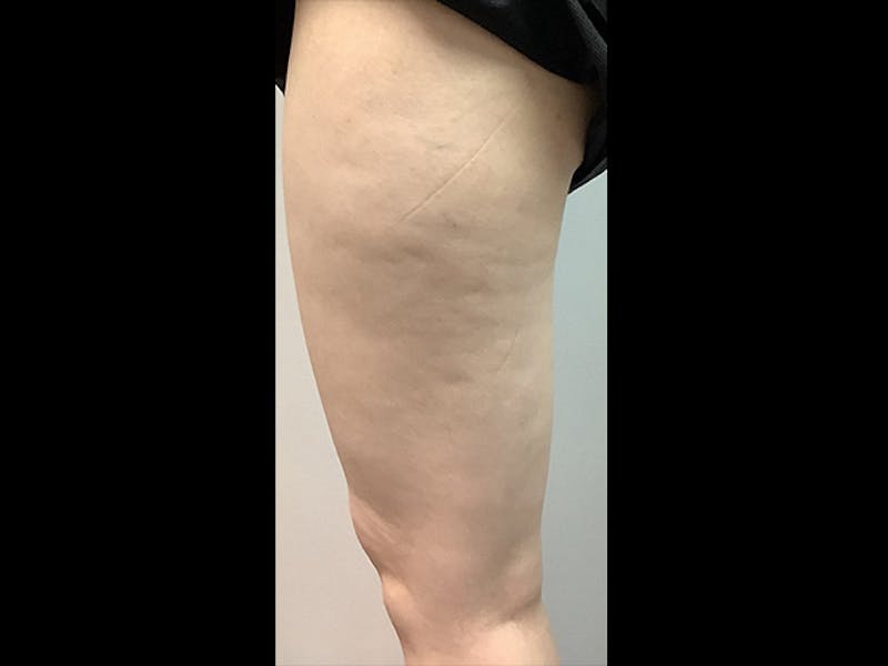Exilis Before & After Gallery - Patient 362904 - Image 1