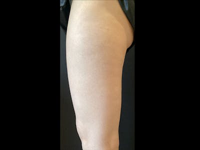 Exilis Before & After Gallery - Patient 362904 - Image 2