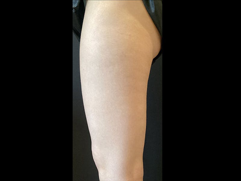 Exilis Before & After Gallery - Patient 362904 - Image 2