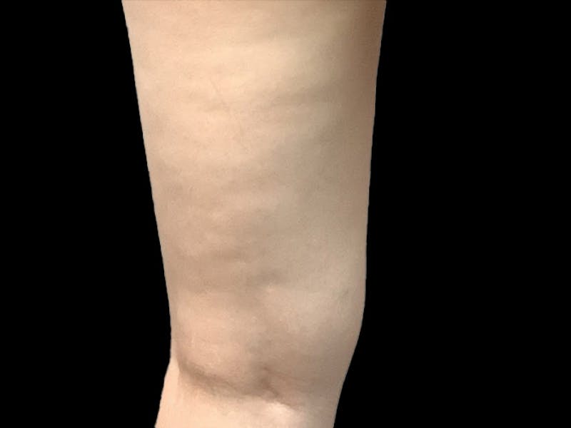 Exilis Before & After Gallery - Patient 273652 - Image 1