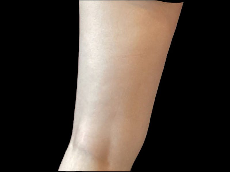 Exilis Before & After Gallery - Patient 273652 - Image 2