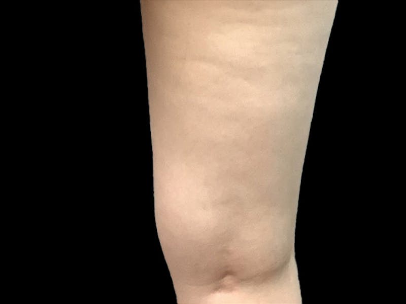 Exilis Before & After Gallery - Patient 273652 - Image 3