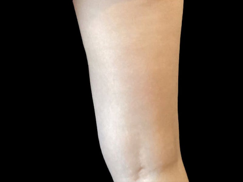 Exilis Before & After Gallery - Patient 273652 - Image 4