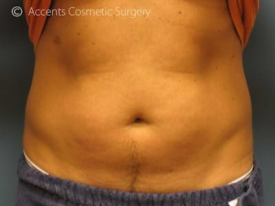 Exilis Before & After Gallery - Patient 416511 - Image 1