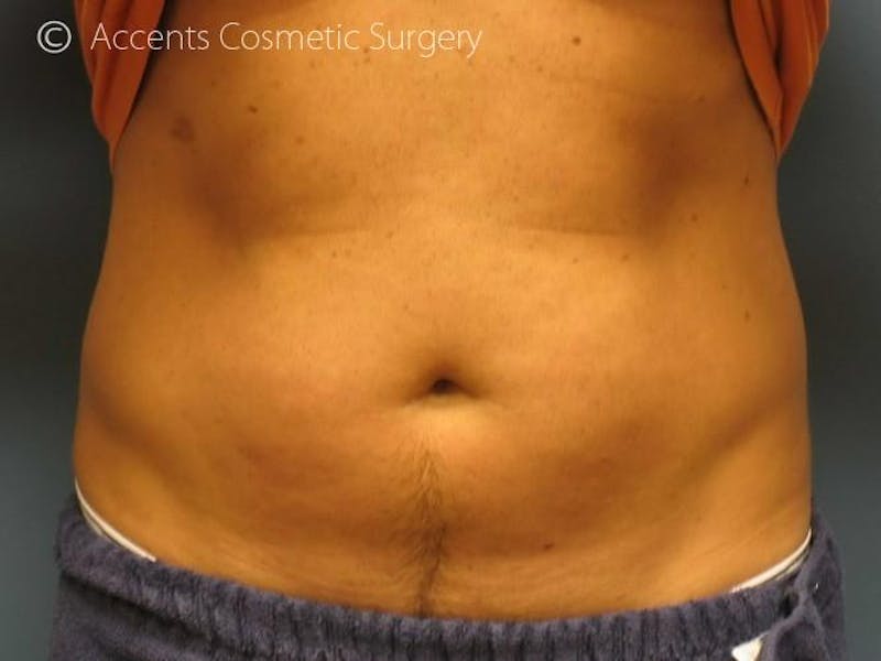 Exilis Before & After Gallery - Patient 416511 - Image 1
