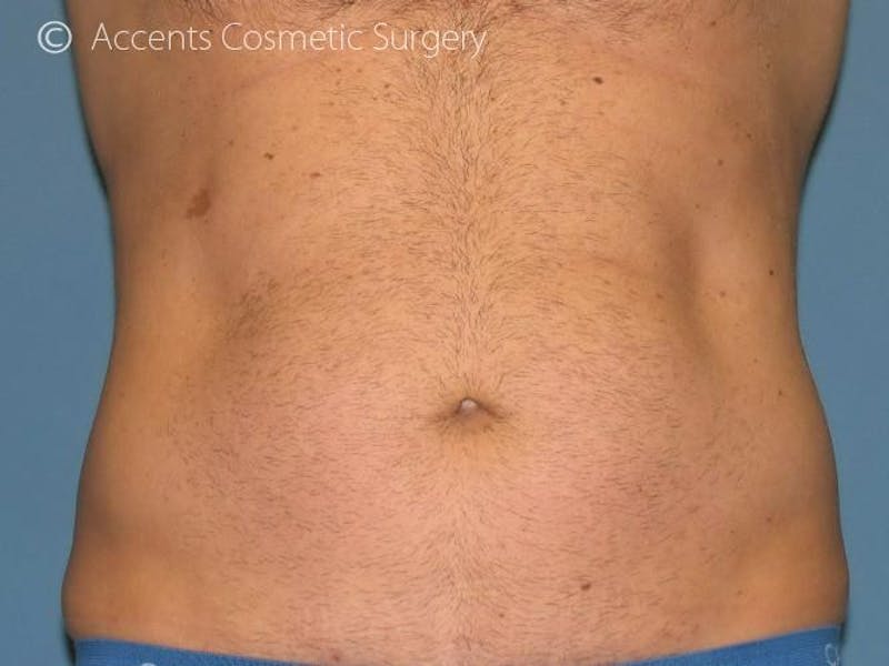Exilis Before & After Gallery - Patient 416511 - Image 2