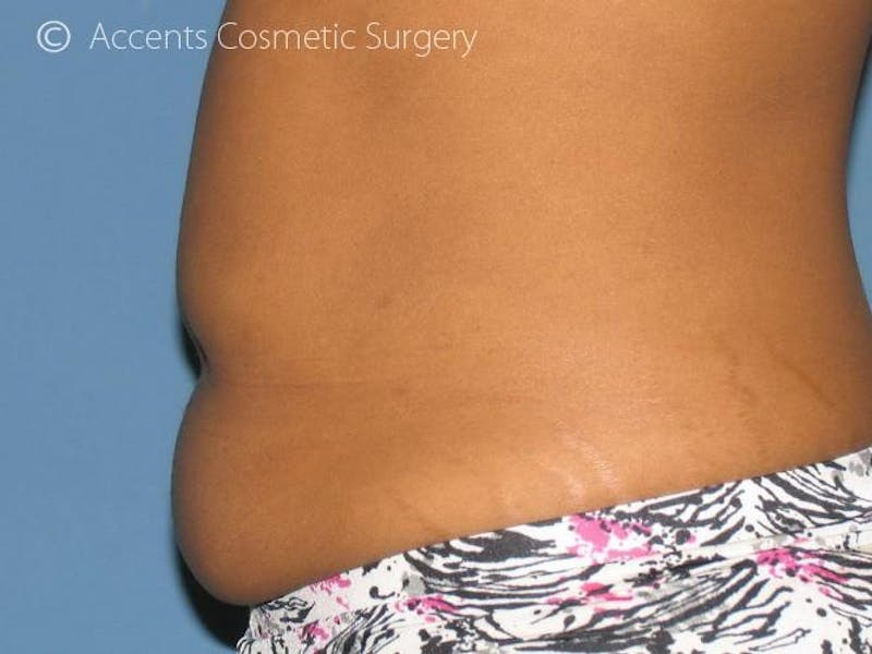 Exilis Before & After Gallery - Patient 128677 - Image 1