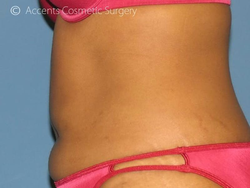 Exilis Before & After Gallery - Patient 128677 - Image 2