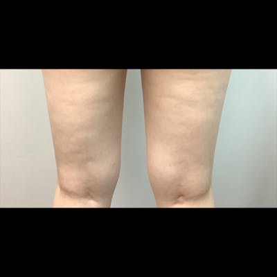 Exilis Before & After Gallery - Patient 448798 - Image 1