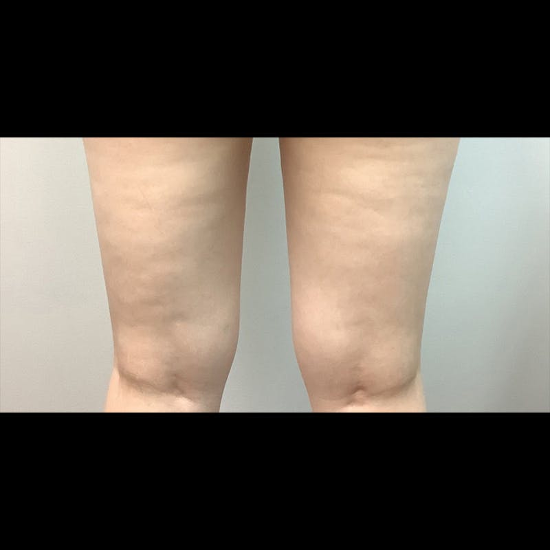 Exilis Before & After Gallery - Patient 448798 - Image 1