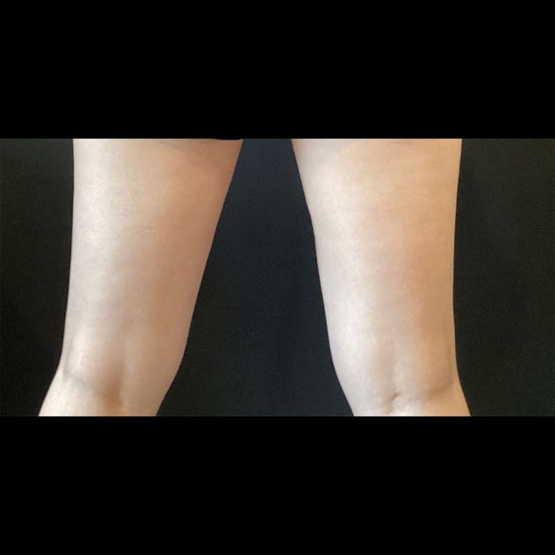 Exilis Before & After Gallery - Patient 448798 - Image 2