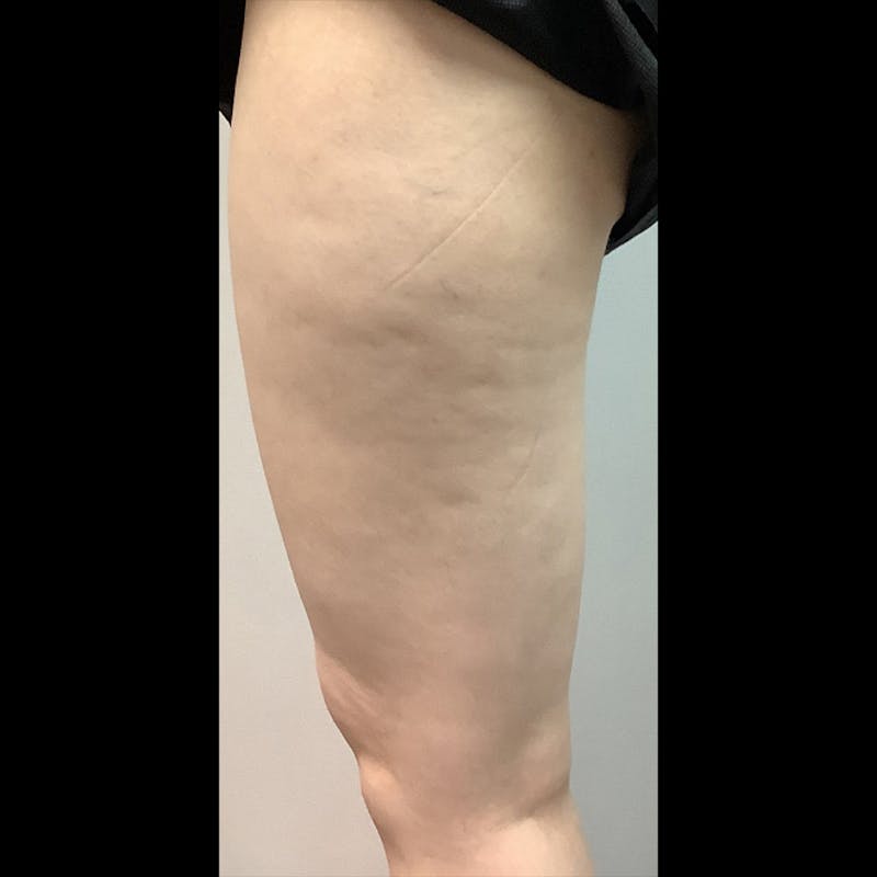 Exilis Before & After Gallery - Patient 448798 - Image 3