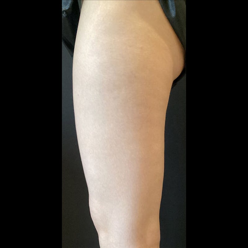 Exilis Before & After Gallery - Patient 448798 - Image 4