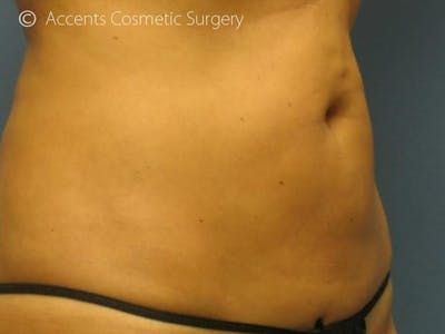 Thermage Before & After Gallery - Patient 208646 - Image 1