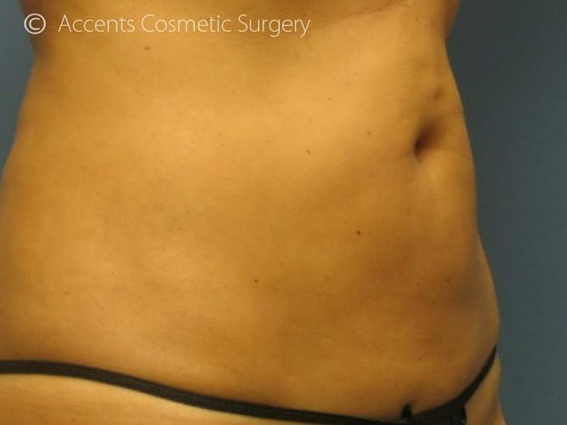Thermage Before & After Gallery - Patient 208646 - Image 1